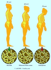 osteoporosi 3