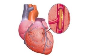 caronaropatia-cardiotool-415x260